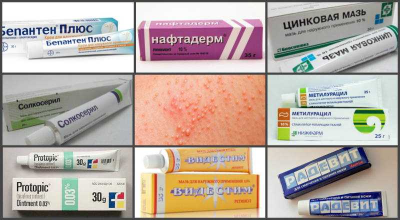 Инфекционный дерматит: как лечить у взрослых и детей
