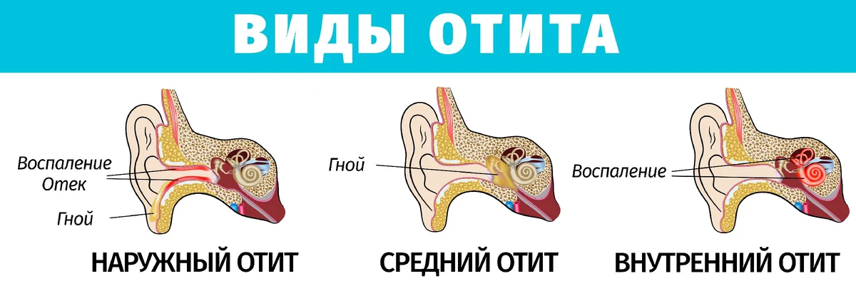 Симптомы и лечение отита