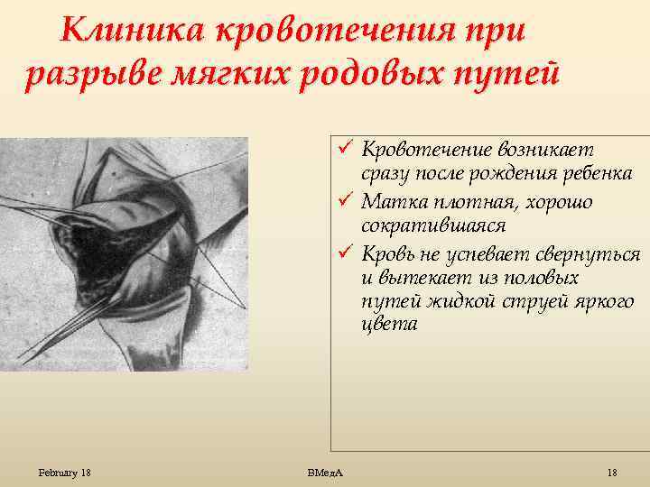 Вмешательство в естественное течение родов: что такое эпизиотомия и зачем она нужна
