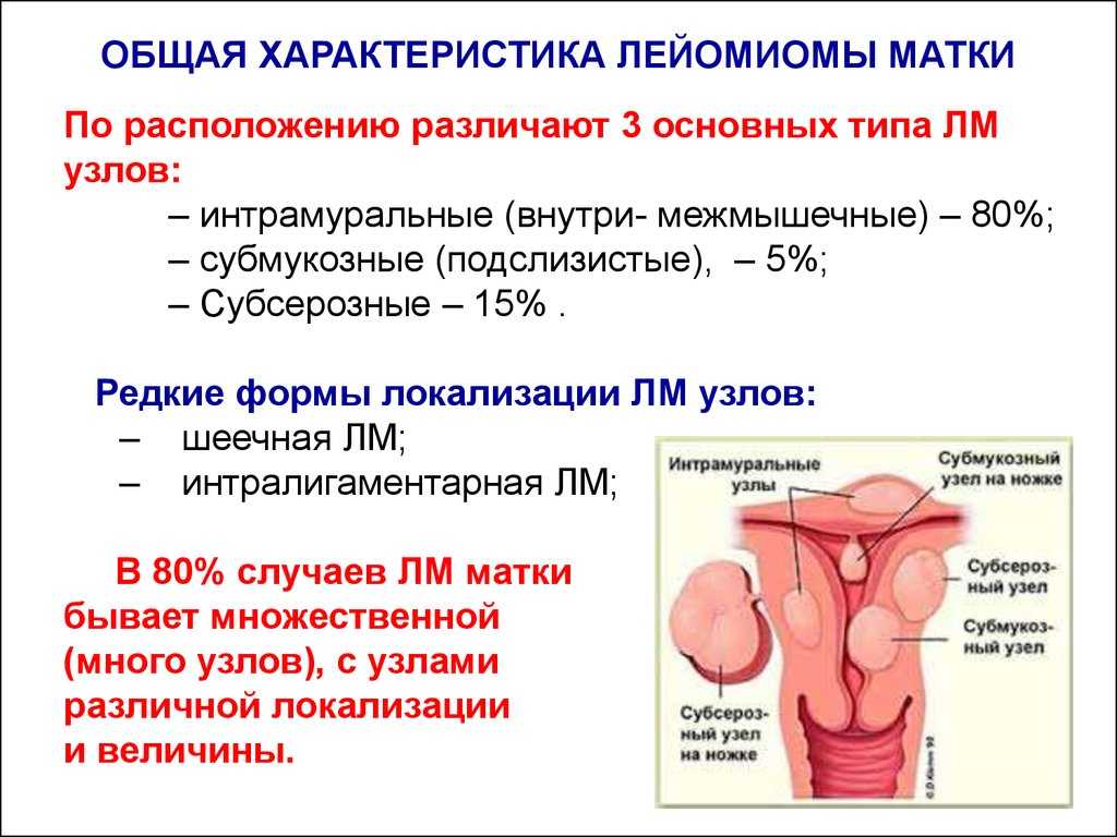 Миома матки. диагностика и лечение. операция удаления миомы (миомэктомия)