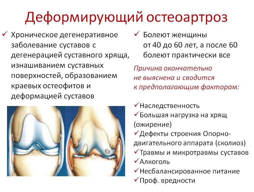 Ювенильный артрит