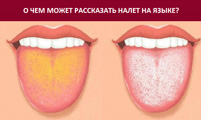 Налёт на языке — о чём говорит