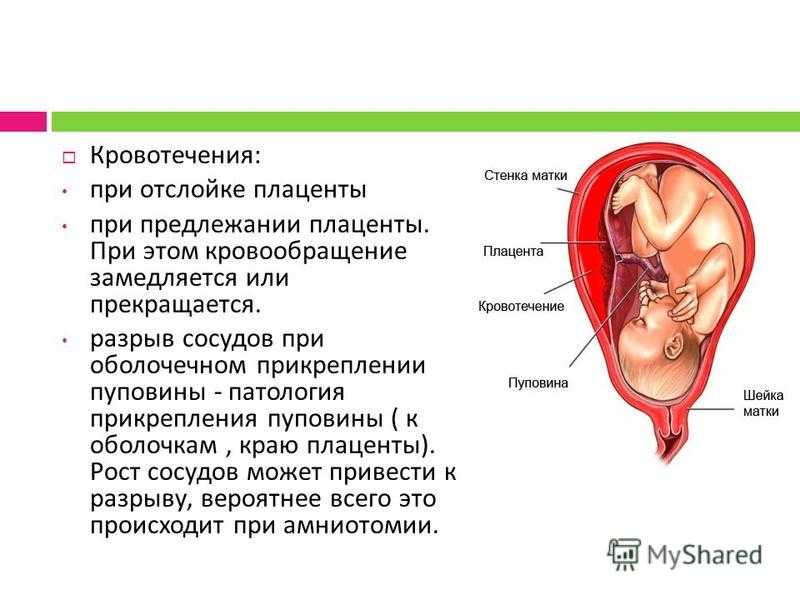 Центральное предлежание плаценты