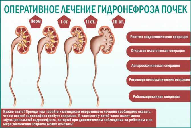 Гидронефроз клиническая картина