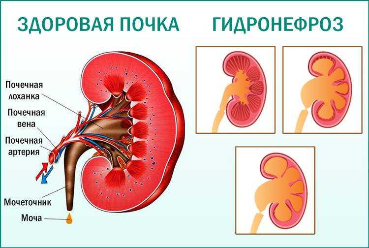 Врожденные нарушения проходимости почечной лоханки и врожденные аномалии мочеточника
