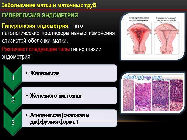 Гиперплазия эндометрия матки презентация