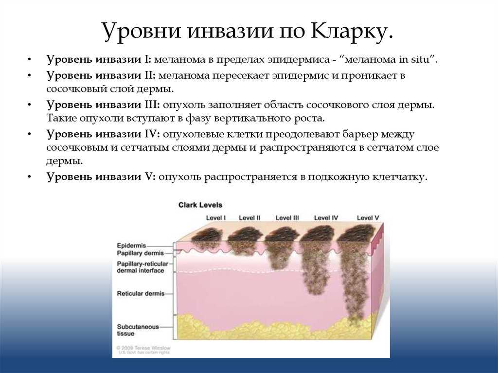 Меланома — причины, симптомы и лечение. почему нужно удалять родинки