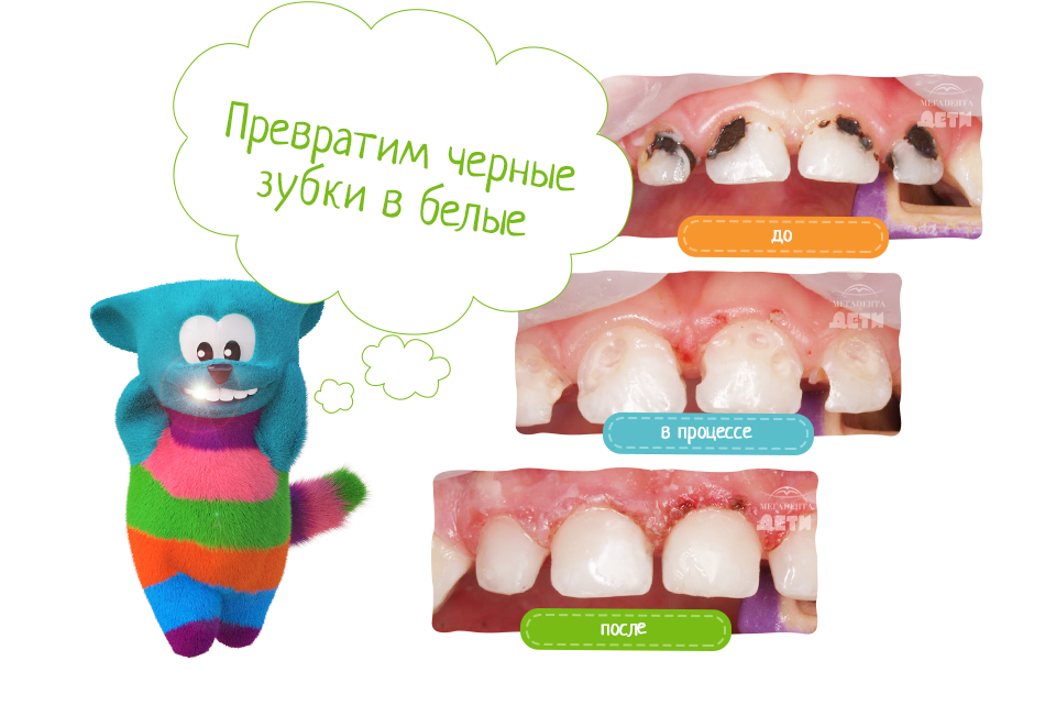 Зубной камень у детей: причины и удаление - underson clinic
