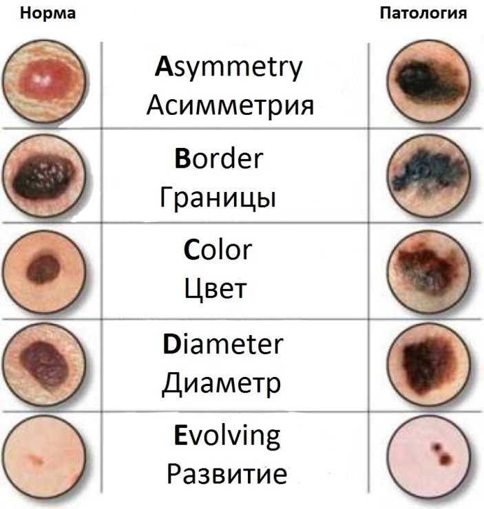 Врожденный пигментный невус у детей, удаление невуса ребенку кожи на голове, шеи или туловище, лечение сосудистого невуса у новорожденных
