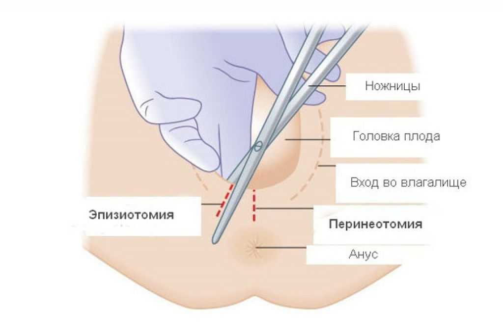 Эпизиотомия: показания, рекомендации