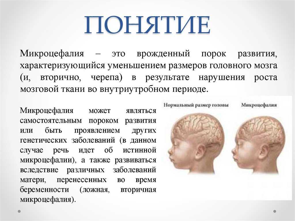 Микроцефалия у детей – редкая болезнь, которая характеризуется поражением головного мозга Что это за болезнь и как лечить