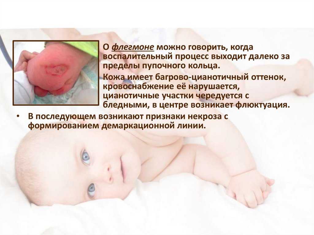 Омфалит у новорожденных: причины и виды заболевания, клинические проявления, диагностика, возможные осложнения