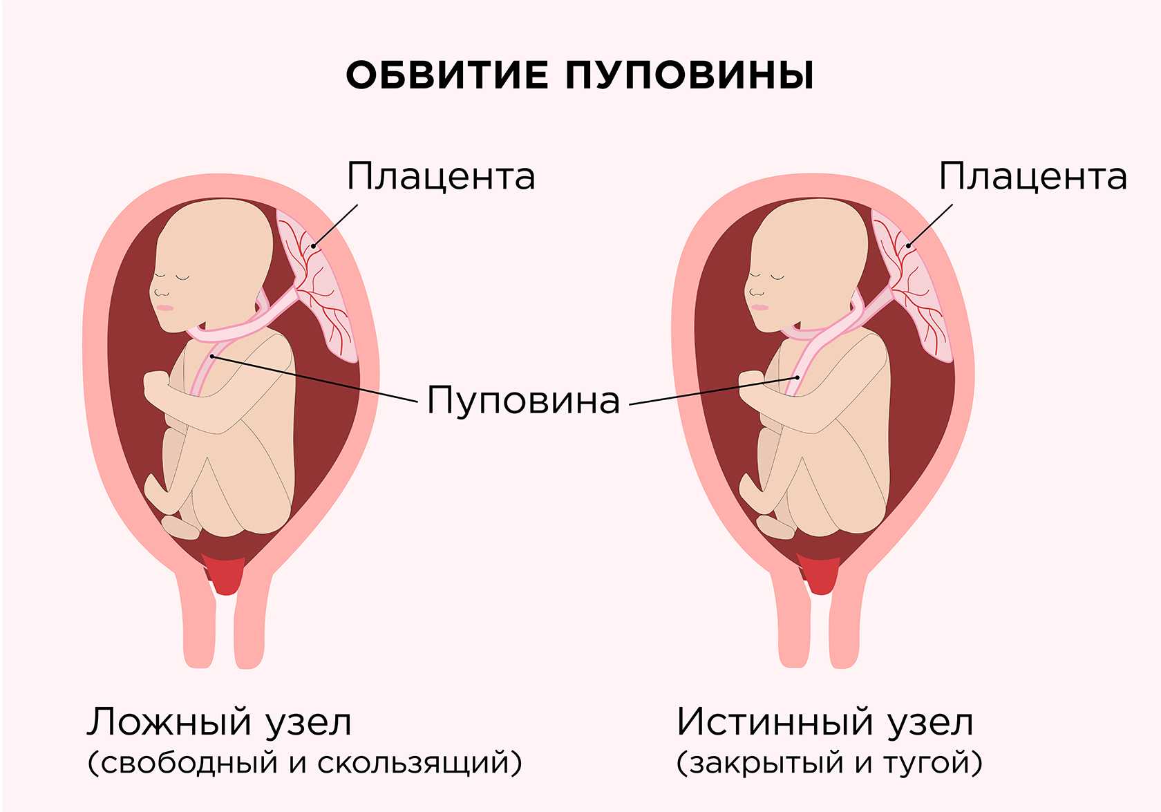 Асфиксия новорожденных
