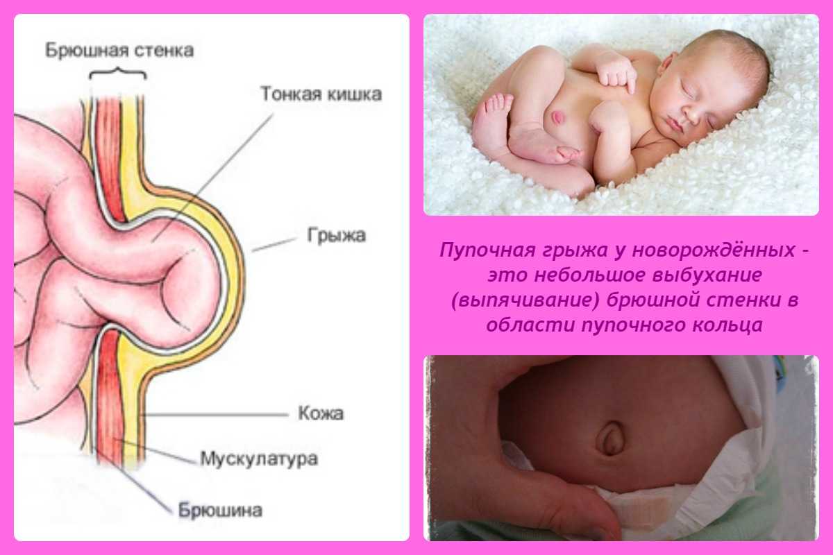 Омфалит - лечение и симптомы