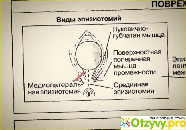 Эпизиотомия как одна из проблем современной перинеологии