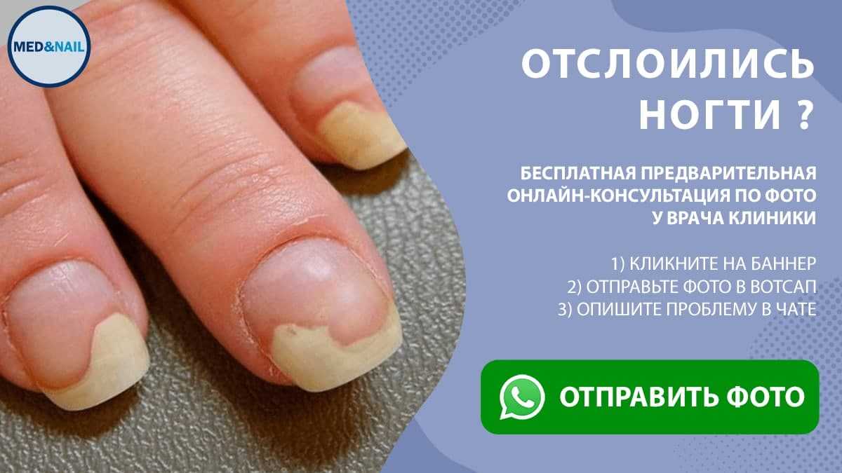 Почему загибаются ногти на руках? и что делать чтобы не закручивались