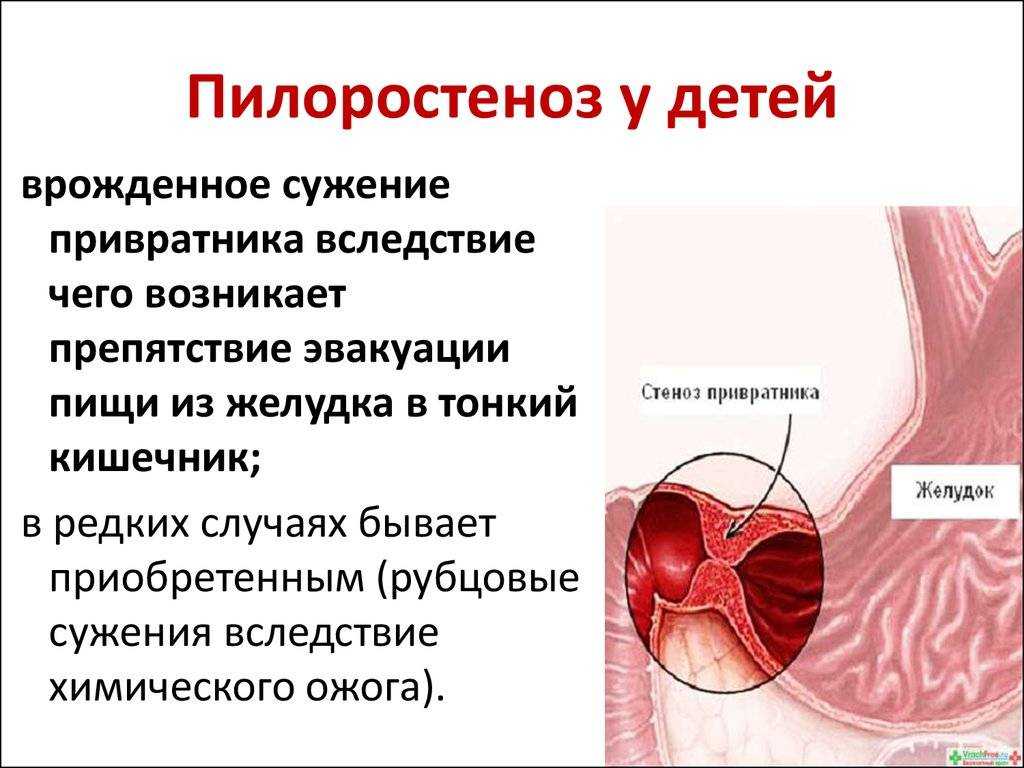 Пилоростеноз у новорожденных: симптоматика, диагностика и лечение
