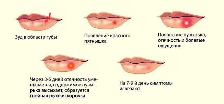 Бартолинит у женщин: диагностика, лечение, профилактика