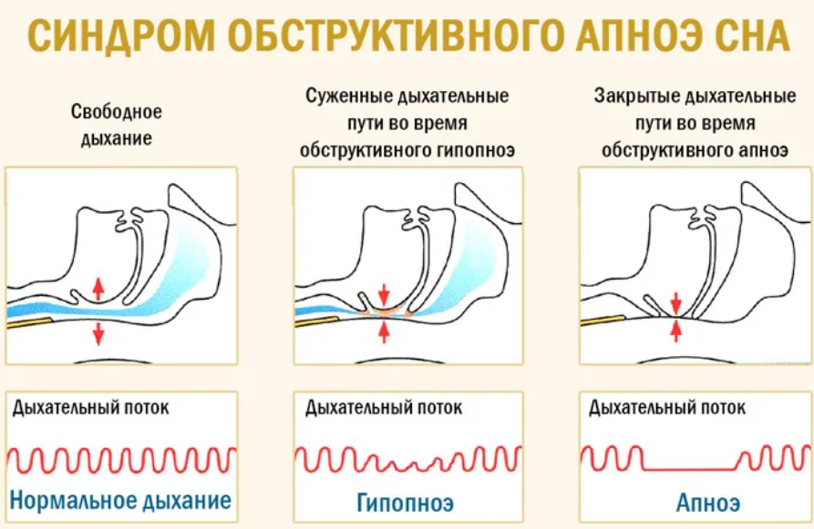 Обструктивное апноэ сна (соагс): алгоритм диагностики и способы лечения!