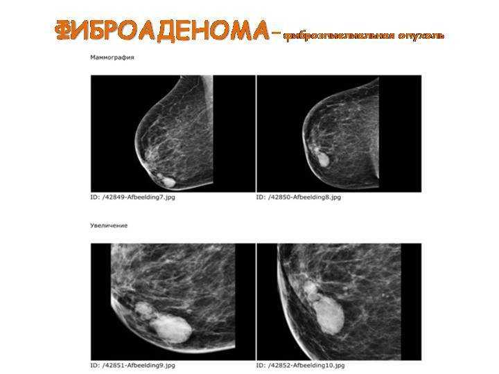 Фиброма в груди. Атипичная фиброаденома маммография. Листовидная фиброаденома на маммографии. Фиброаденома молочной железы Строма. Маммография фиброаденома.