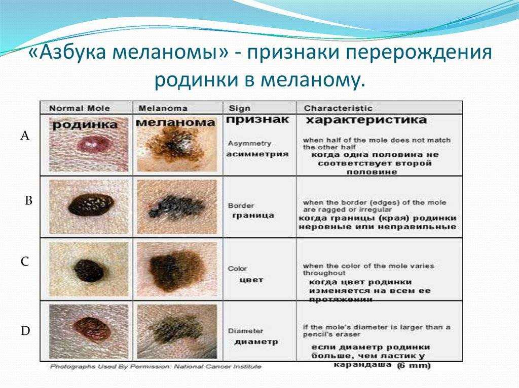 Родинки у детей - интервью с дерматоонкологом