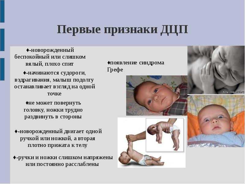 Симптом заходящего солнца у новорожденных. что это такое, когда проходит