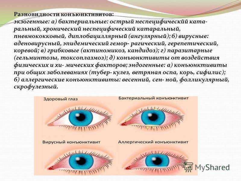 Конъюнктивит у ребенка. лечение конъюнктивита у детей, симптомы и причины