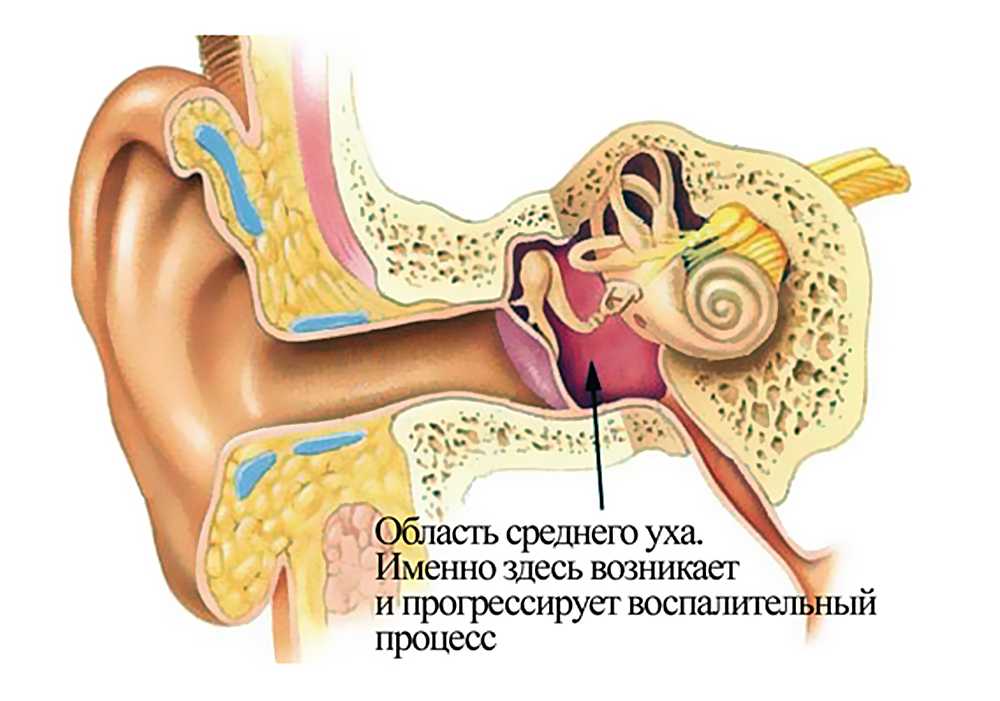 Острый средний отит у детей: симптомы и лечение