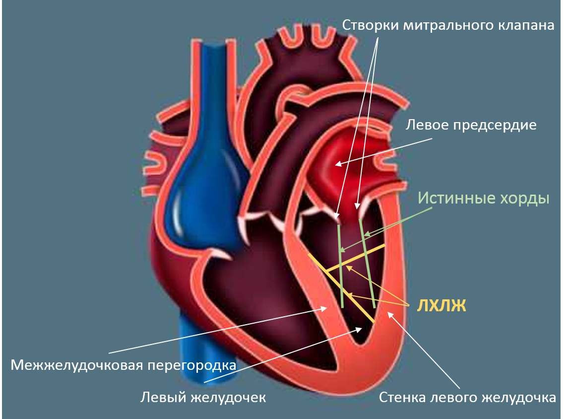 Марс в кардиологии. Дополнительная хорда в левом желудочке сердца. Дополнительная хорда митрального клапана. Хорда левого желудочка сердца. Ложная хорда левого желудочка у ребенка.
