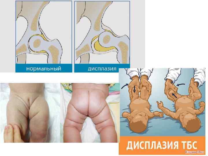 Дисплазия тазобедренного сустава ortoped-klinik.com
