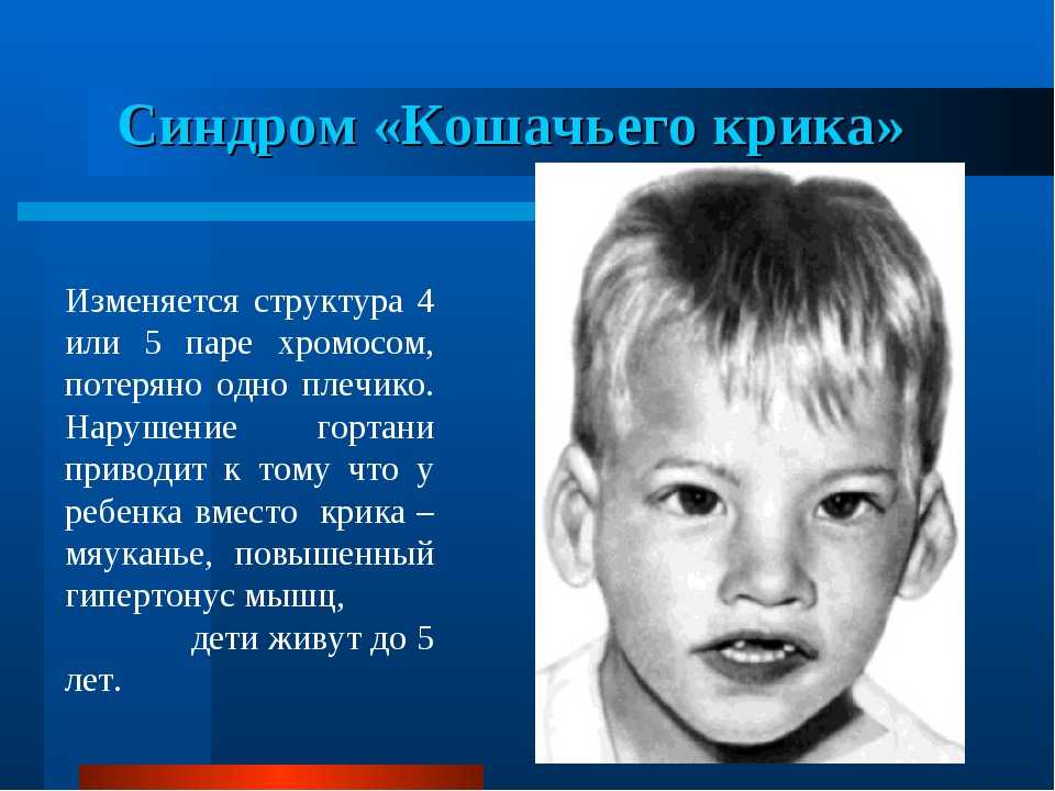 Умственная отсталость: стадии (степени), симптомы и другие сведения