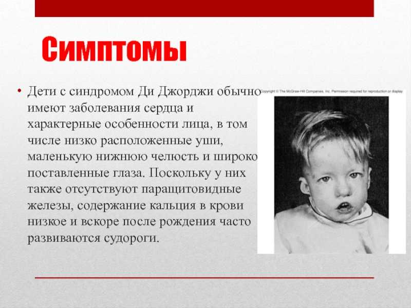Синдром делеции 22q11.2 (ди джорджи) - медико-генетический центр мама папа