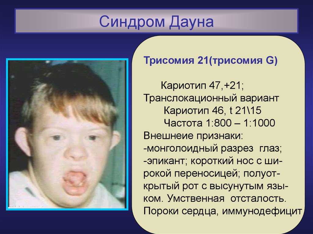 Синдром дауна: мифы и факты