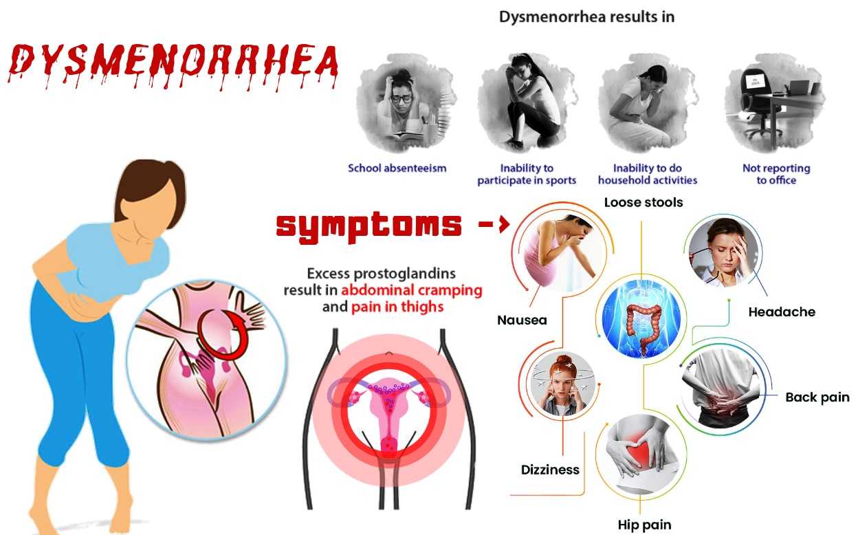Дисменорея симптомы. Первичная дисменорея. Дисменорея первичная и вторичная. Вторичная альгодисменорея. Причины первичной дисменореи.