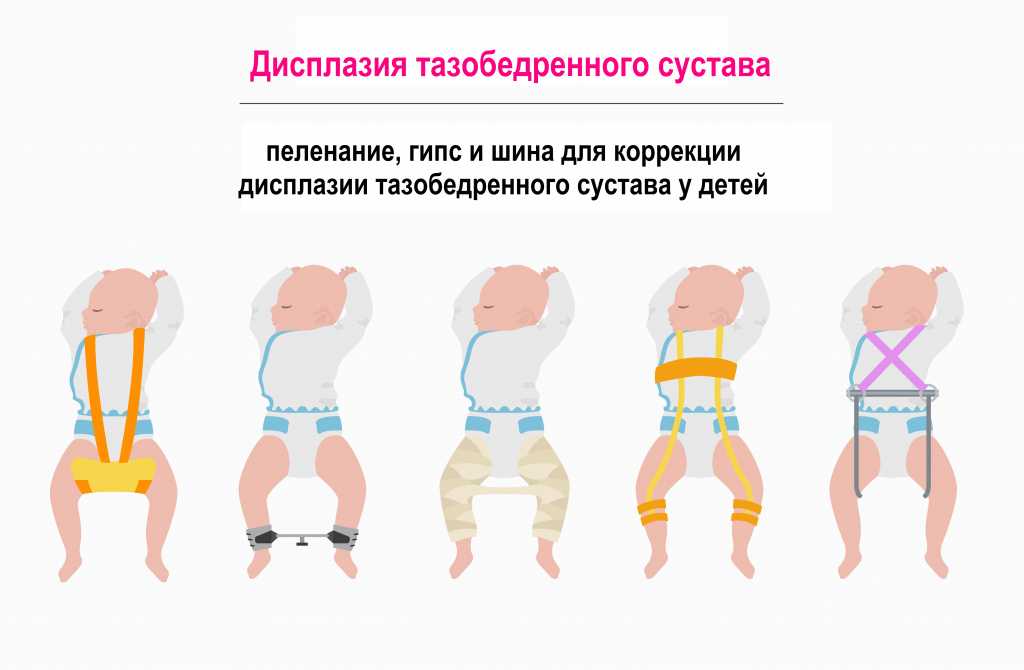Дисплазия тазобедренных суставов: диагностика и лечение