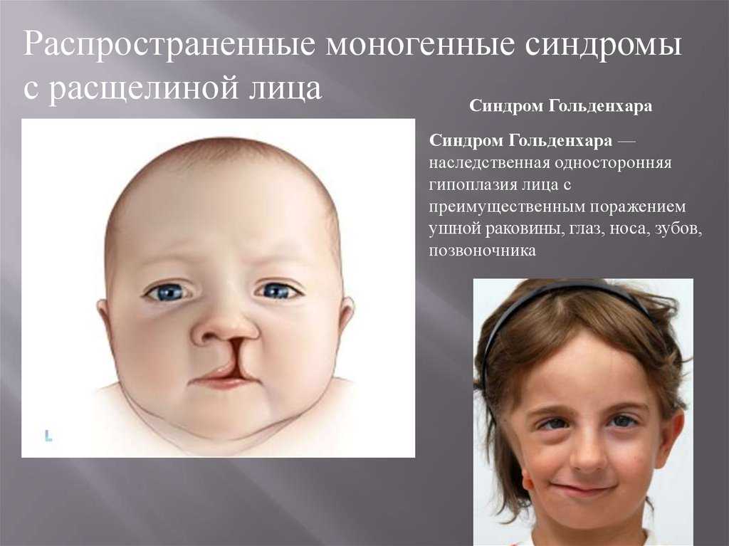 Волчья пасть