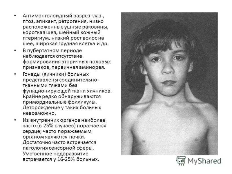 Первичный иммунодефицит. синдром ди джорджи