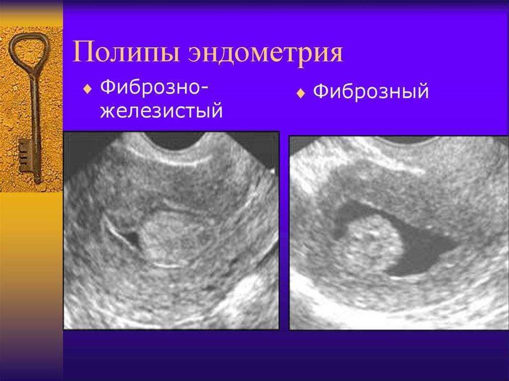 Гистероскопия матки: операция по удалению полипа эндометрия, послеоперационный период при гистероскопии шейки матки | клиники «евроонко»