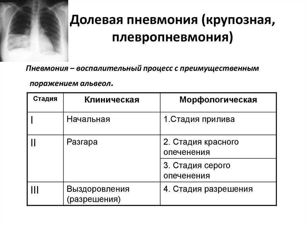 Пневмония у взрослых и детей. как вылечить раз и навсегда