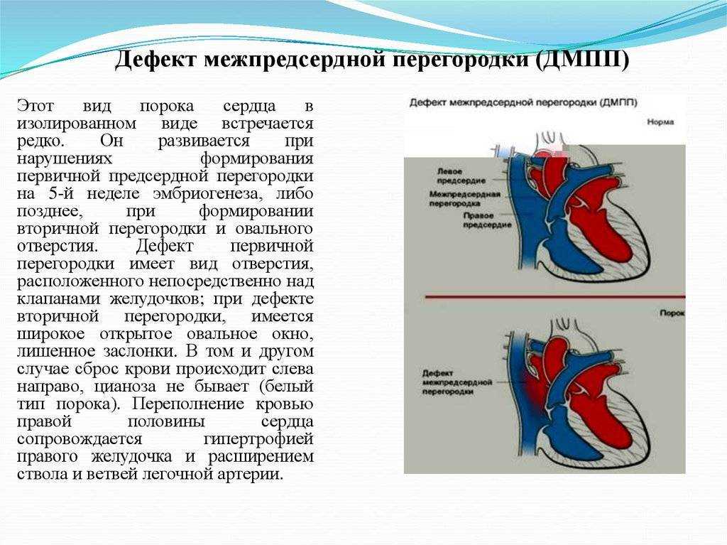 Эндоваскулярная операция —  закрытие дмпп окклюдером