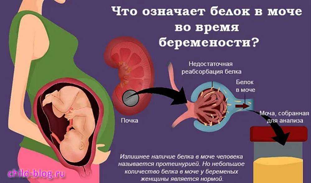 Белок в моче при беременности: норма и отклонения