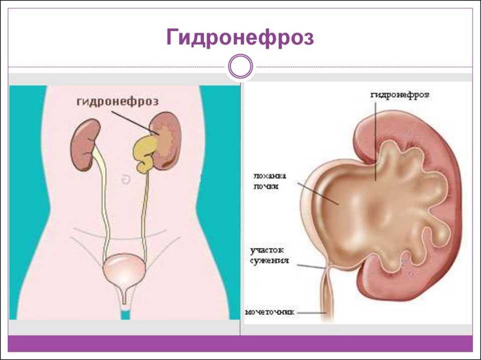 Гидронефроз у плода, новорожденных и детей - ims clinic