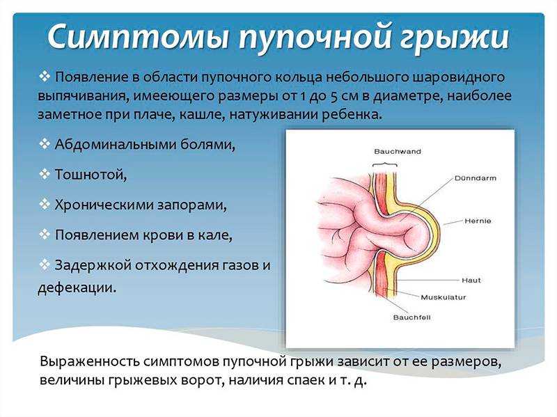 Симптомы грыжи живота. Пупочная грыжа дифференциальная диагностика у детей. Симптомы от грыжи пупочной. Пупочная грыжа дифференциальная диагностика у взрослых женщин. Пупочная грыжа у взрослых симптомы.