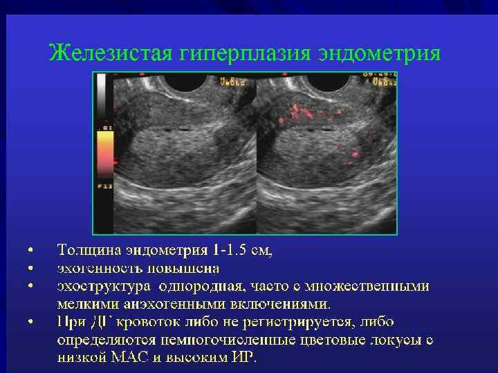 Гиперплазия матки в менопаузе чем опасно. Неатипическая гиперплазия эндометрия. Железистая гиперплазия на УЗИ. УЗИ признаки гиперплазии эндометрия. Гиперплазия эндометрия УЗИ критерии.