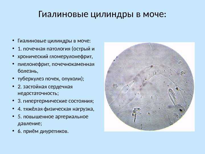 Цилиндры в моче что это значит: гиалиновые, зернистые, патологические при беременности, у ребенка - причины