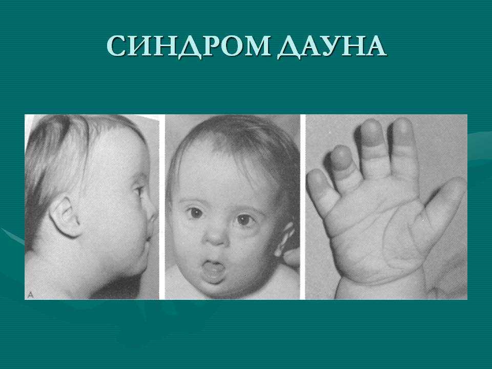 Синдром дауна – признаки, причины и диагностика