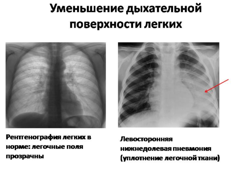Почему уменьшается легкое. Левосторонняя нижнедолевая пневмония рентгенограмма. Левосторонняя нижнедолевая пневмония рентген. Правосторонняя нижнедолевая очаговая пневмония рентген. Очаговая нижнедолевая пневмония.