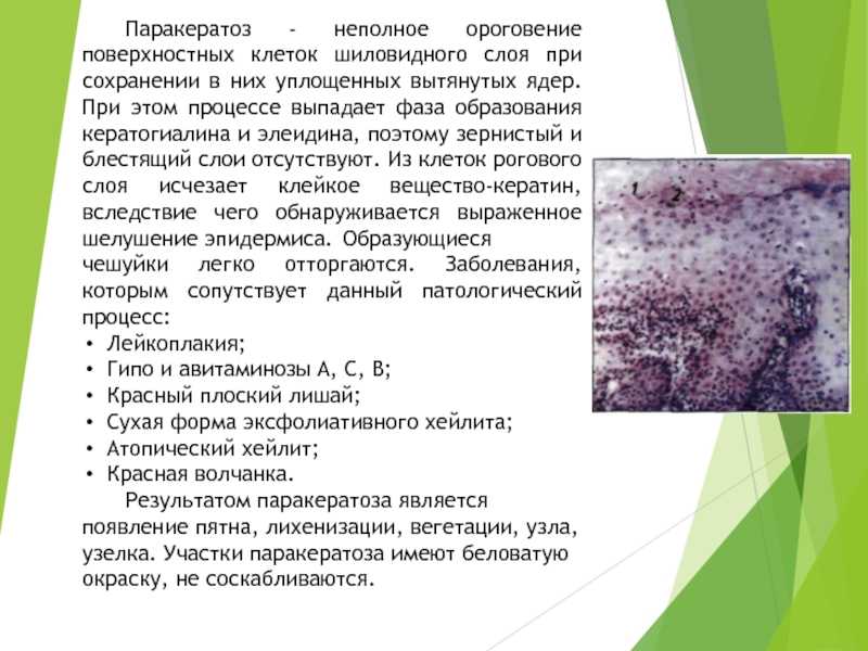 Эрозия шейки матки: причины, лечение, симптомы, стадии заболевания