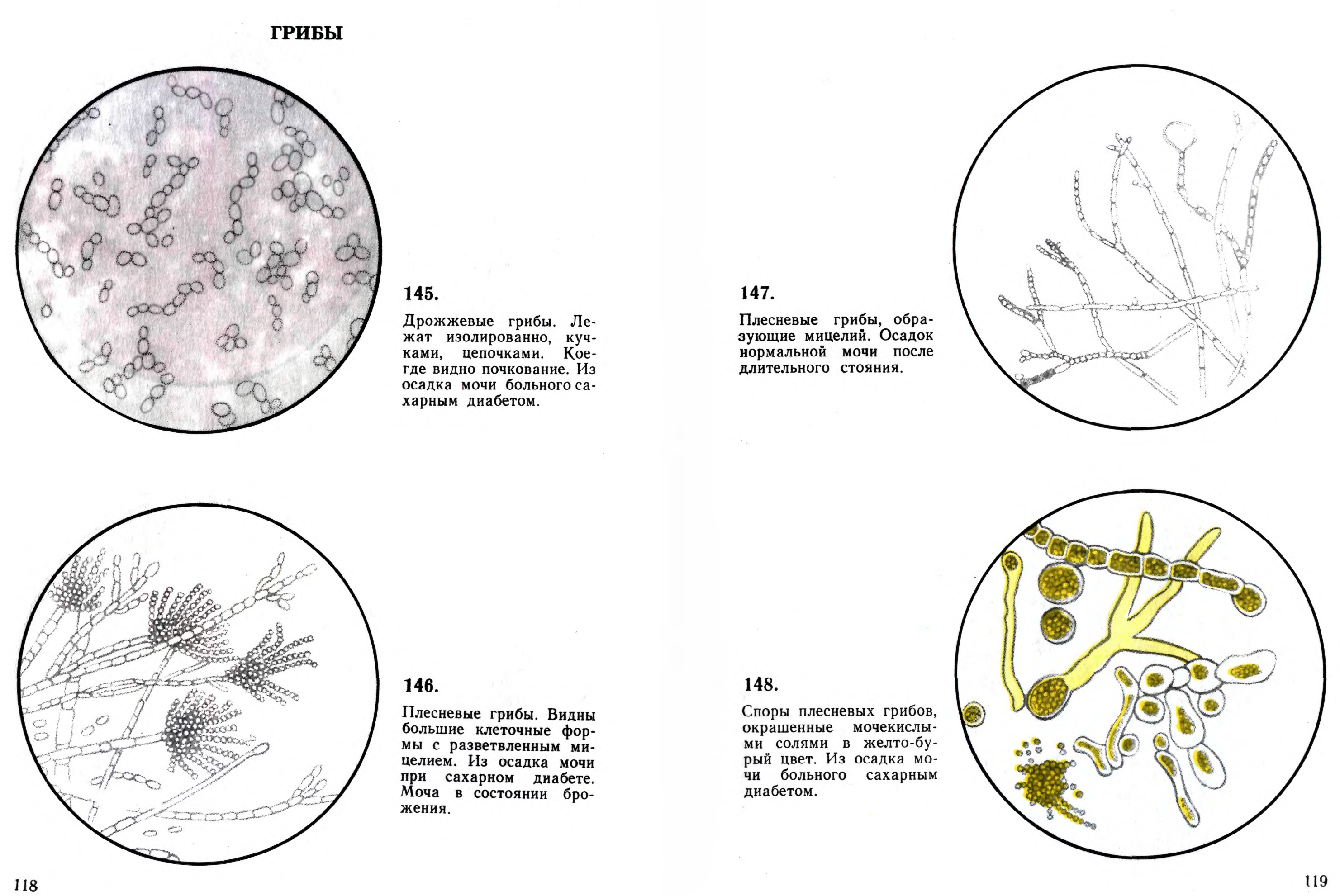 Грибы в кале. Микроскопия осадка мочи атлас. Дрожжевые грибы в моче. Дрожжи в моче микроскопия. Кандида в Кале при микроскопии.
