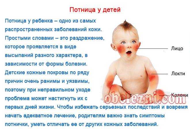 Как лечить потницу?
